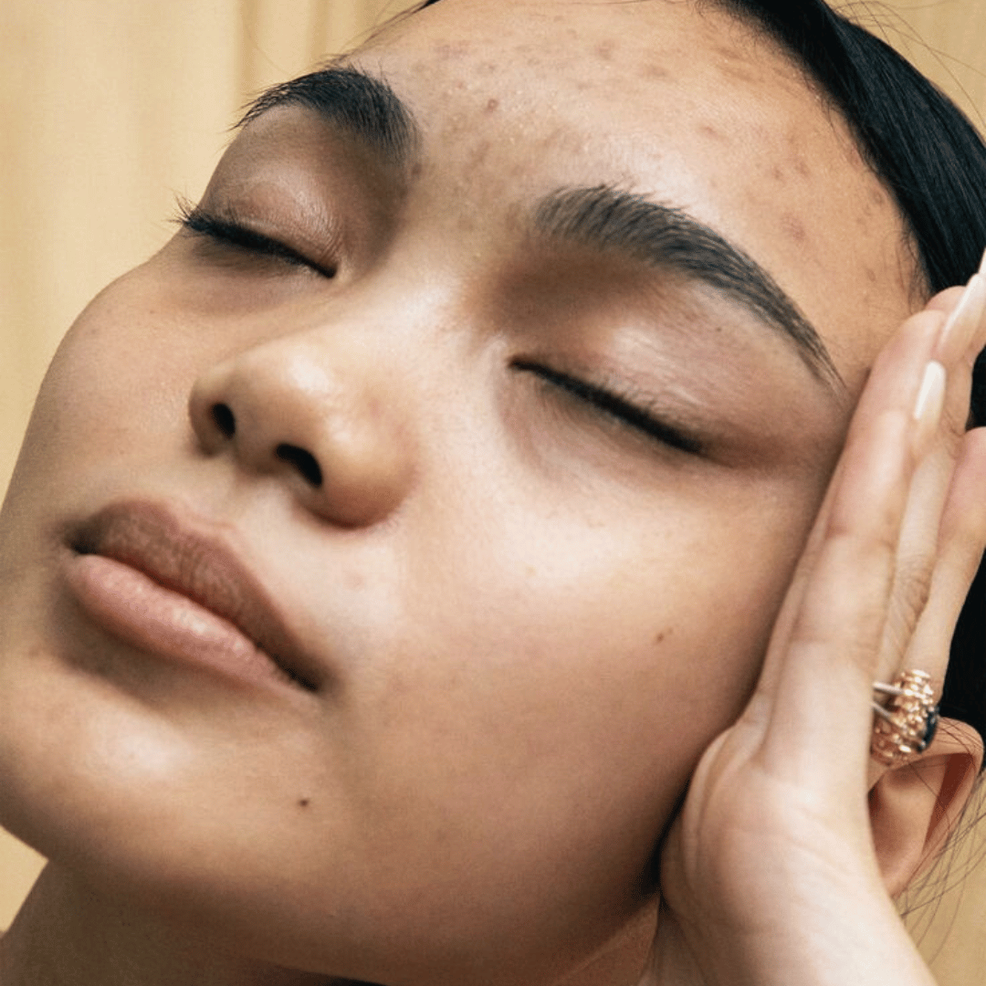 Post- pil acne voorkomen na het stoppen met de pil: 6 praktische tips